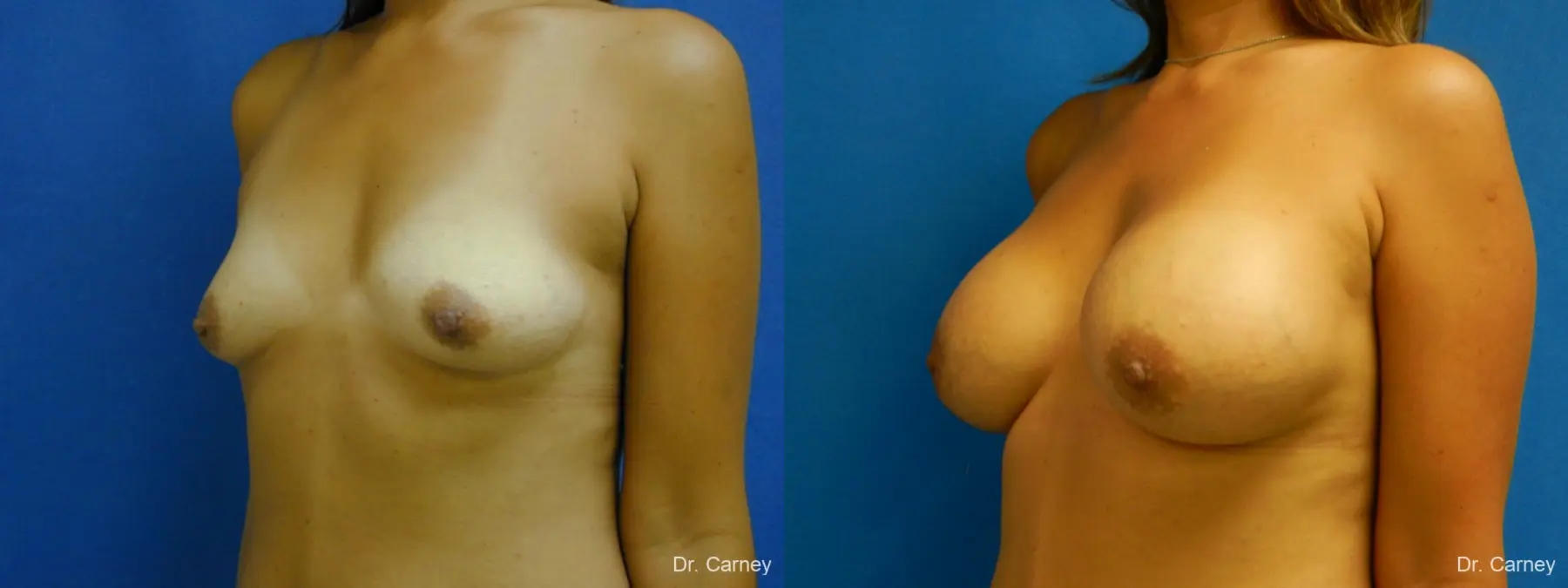 Virginia Beach Breast Augmentation 1860 - Before and After 4