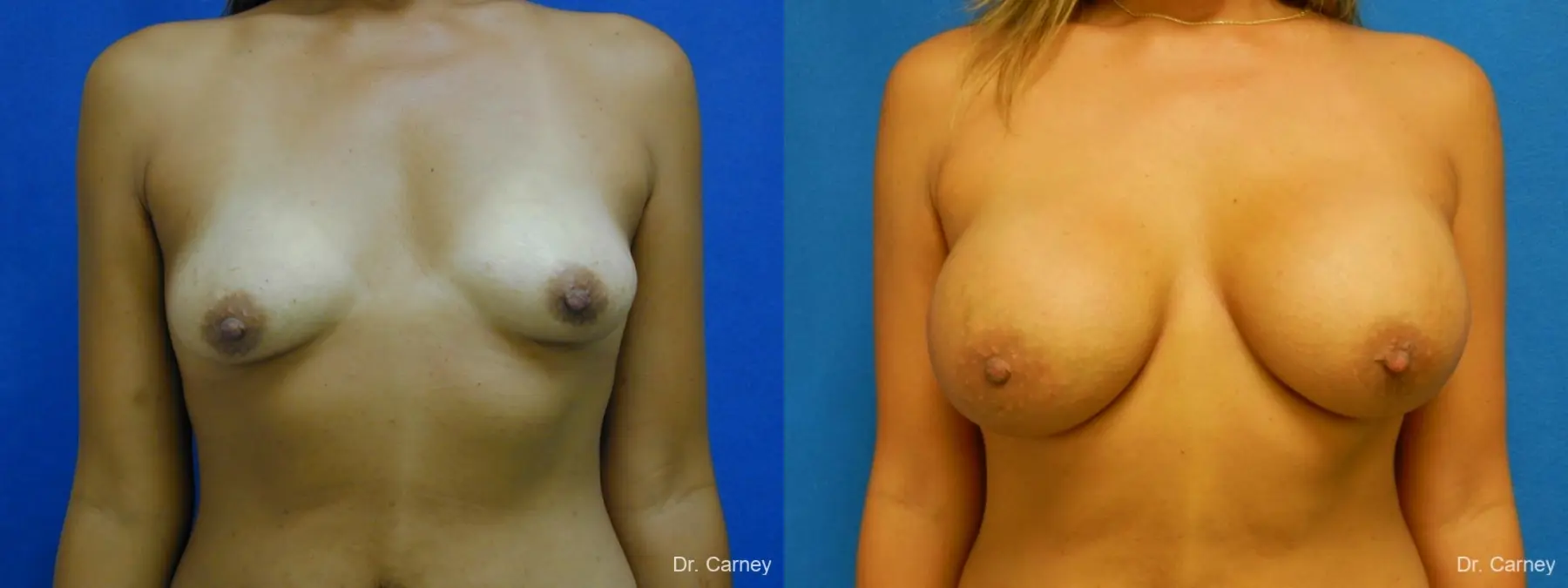 Virginia Beach Breast Augmentation 1860 - Before and After 1