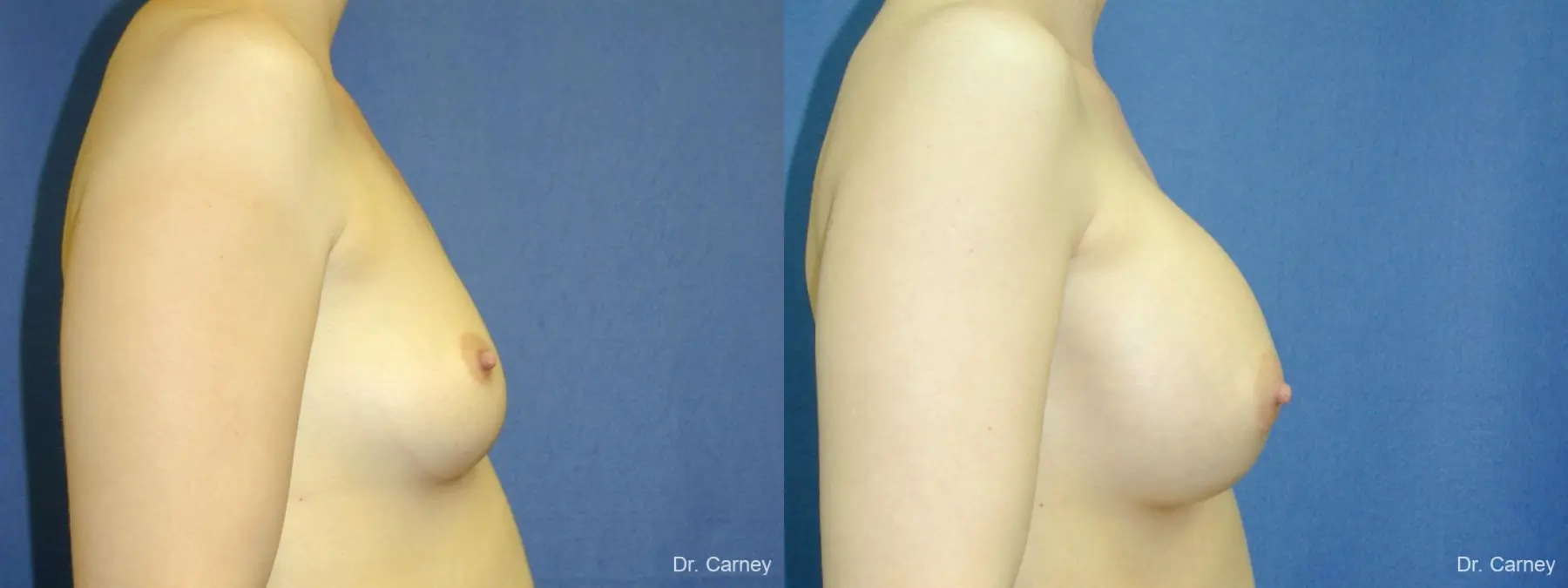 Virginia Beach Breast Augmentation 1086 - Before and After 1