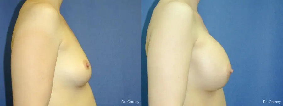 Virginia Beach Breast Augmentation 1086 - Before and After 1
