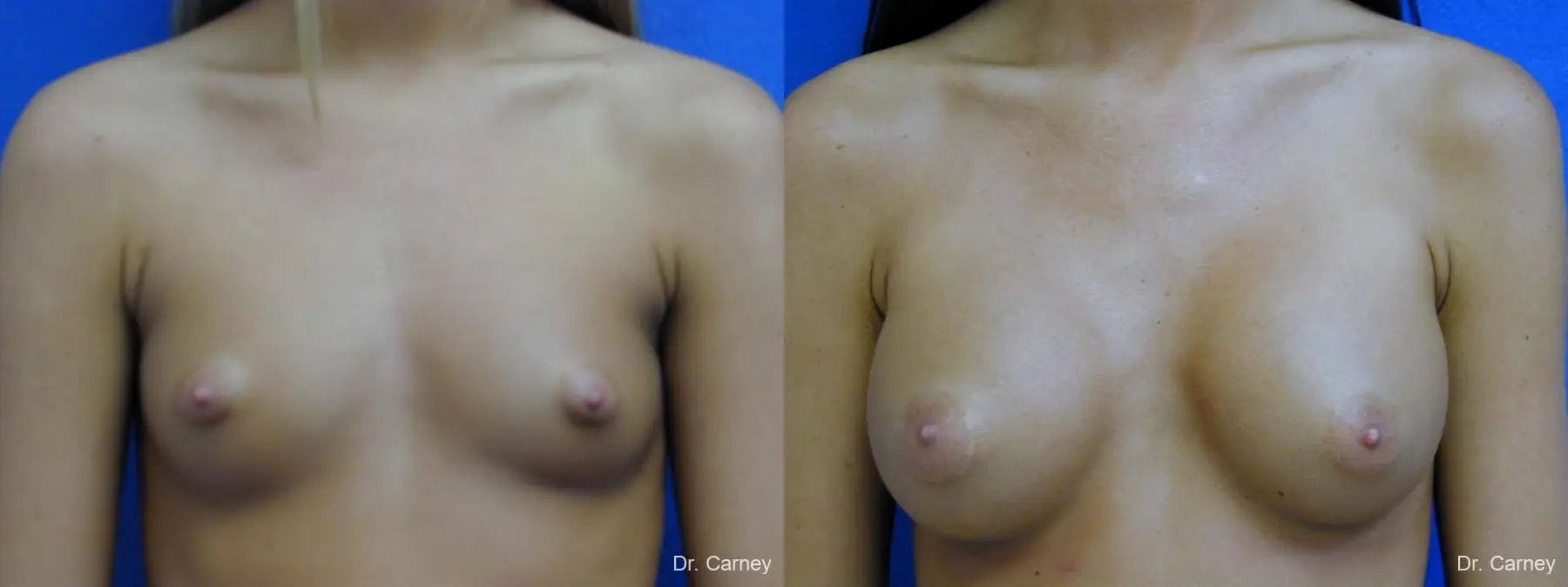 Virginia Beach Breast Augmentation 1082 - Before and After 3