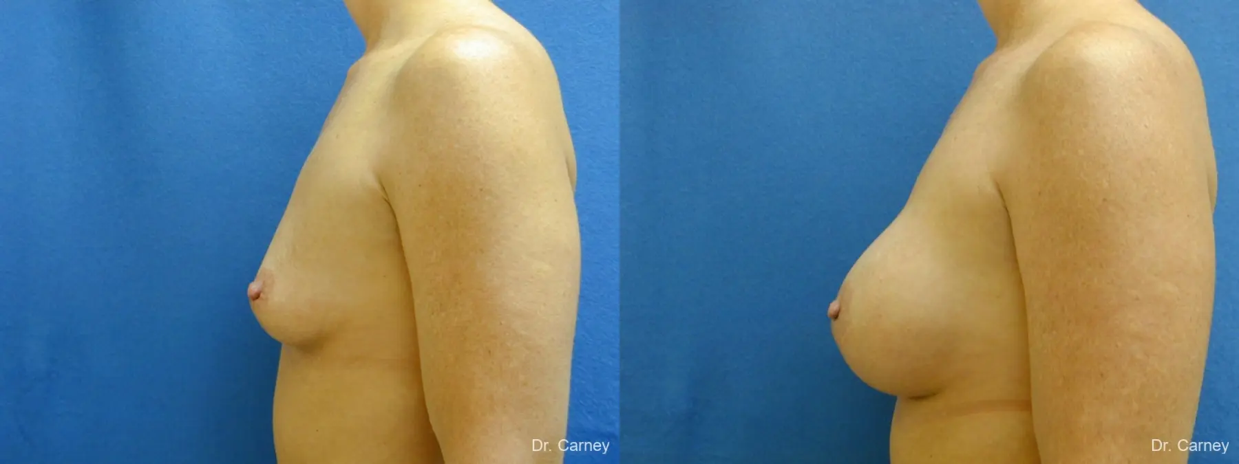 Virginia Beach Breast Augmentation 1214 - Before and After 5