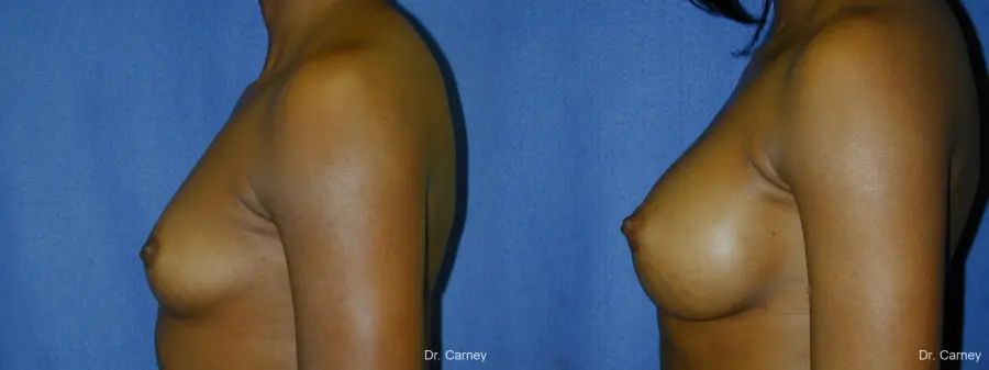Virginia Beach Breast Augmentation 1085 - Before and After 1