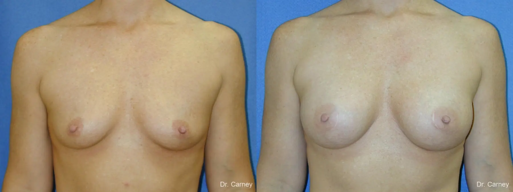 Virginia Beach Breast Augmentation 1081 - Before and After 3