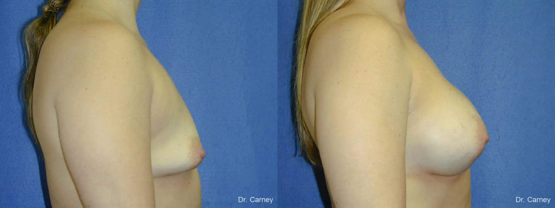 Virginia Beach Breast Augmentation 1083 - Before and After 1