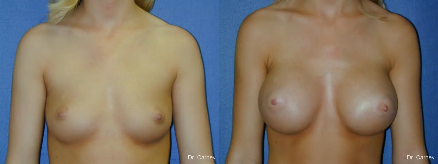 Virginia Beach Breast Augmentation 1092 - Before and After 3
