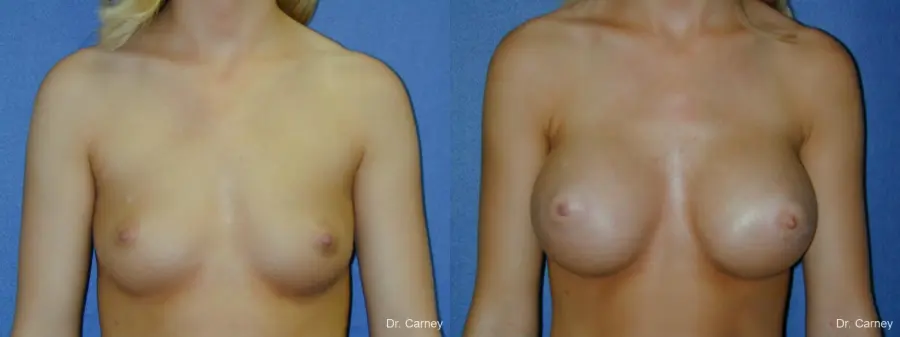 Virginia Beach Breast Augmentation 1092 - Before and After 3