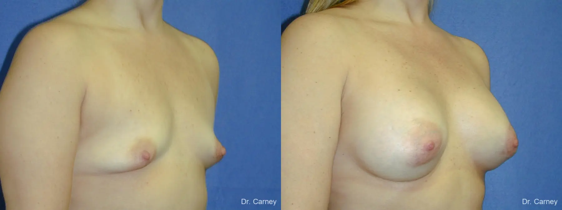 Virginia Beach Breast Augmentation 1083 - Before and After 2