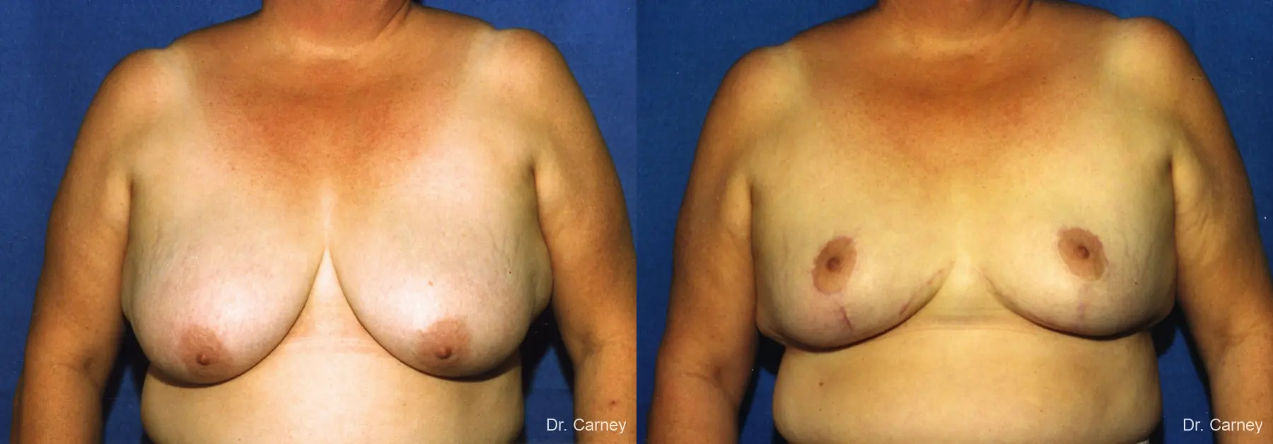 Virginia Beach Breast Lift 1186 - Before and After