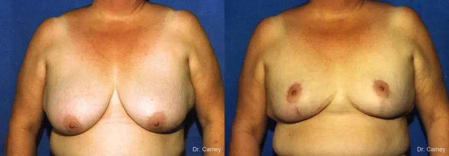 Virginia Beach Breast Lift 1186 - Before and After 1