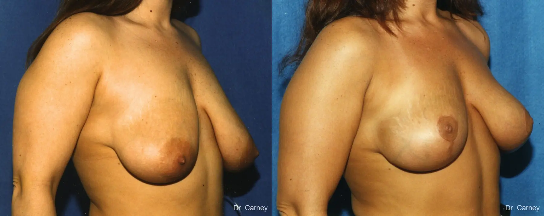 Virginia Beach Breast Lift 1187 - Before and After 1