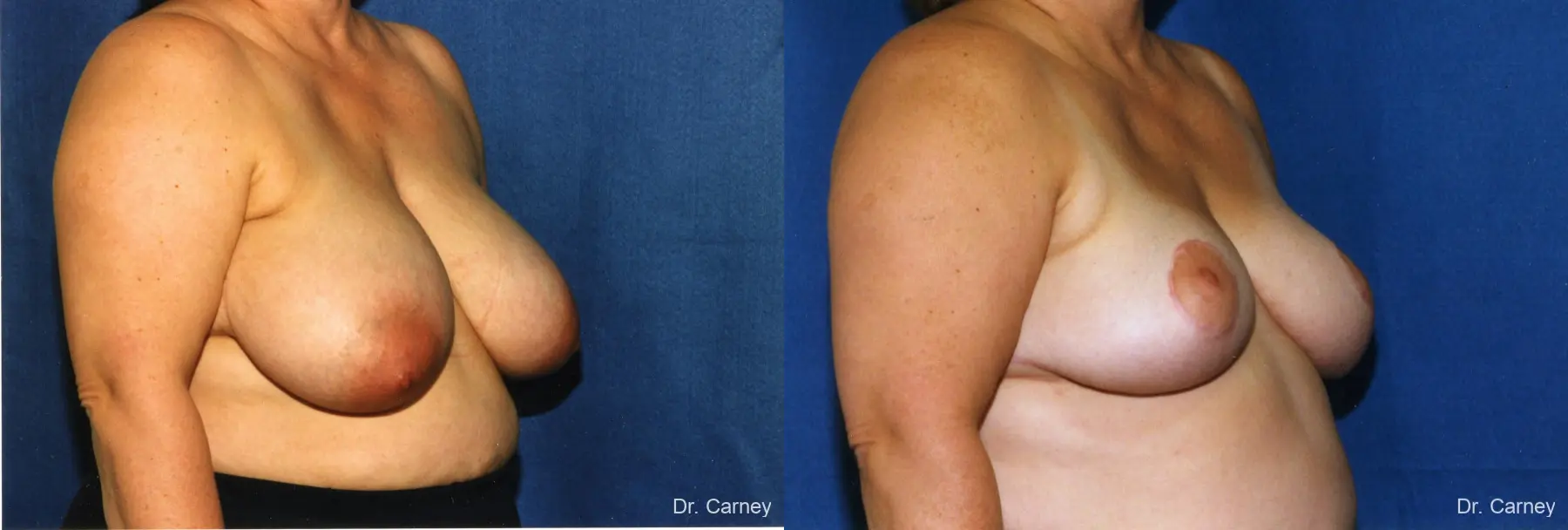 Virginia Beach Breast Lift 1188 - Before and After 1