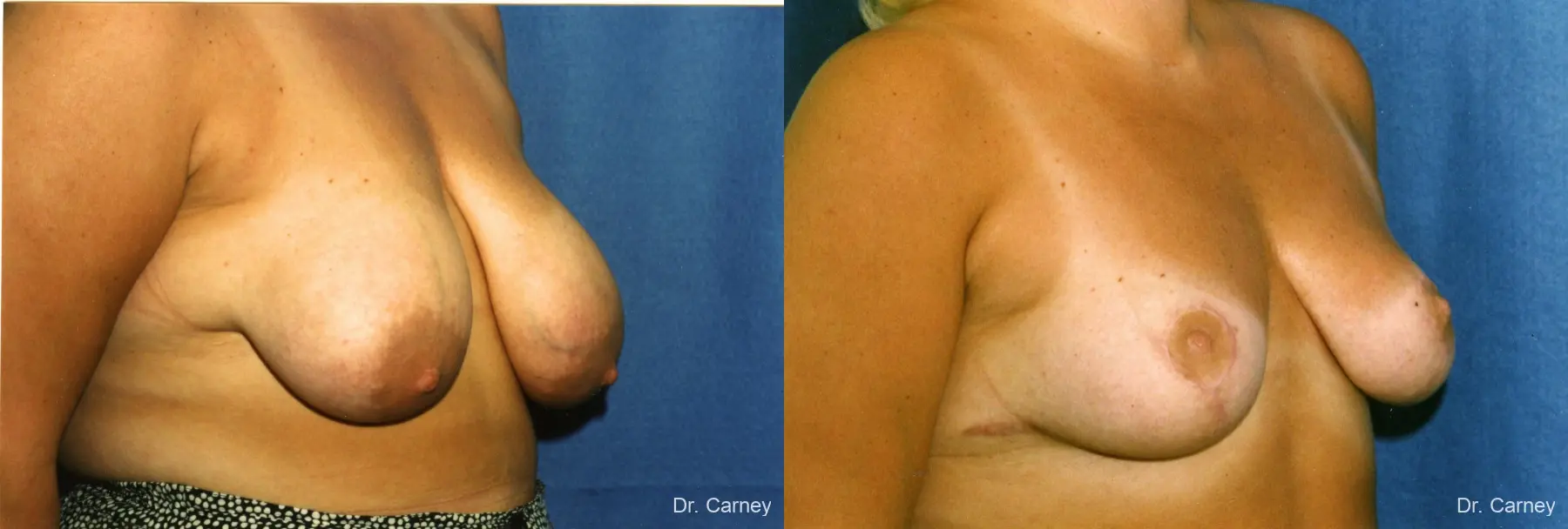 Virginia Beach Breast Lift 1190 - Before and After 1