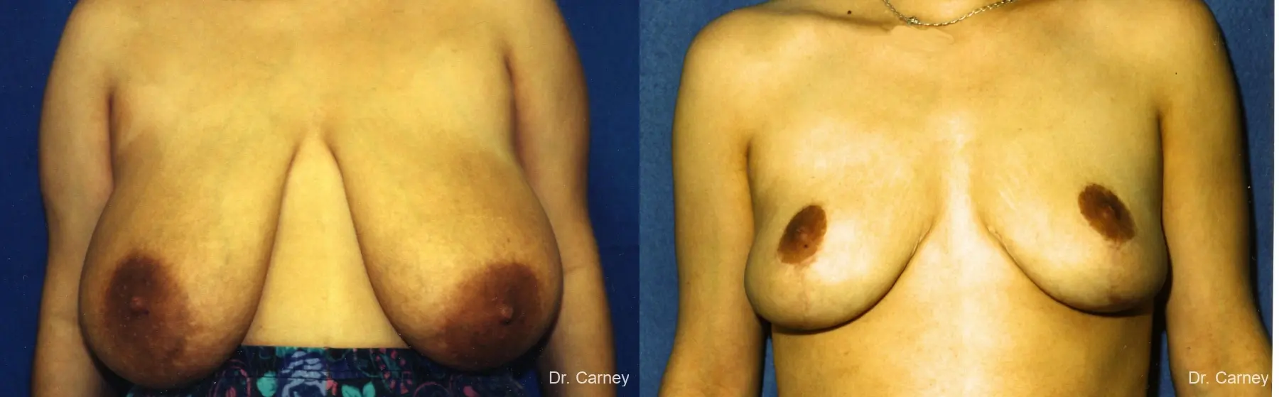 Virginia Beach Breast Lift 1191 - Before and After 1