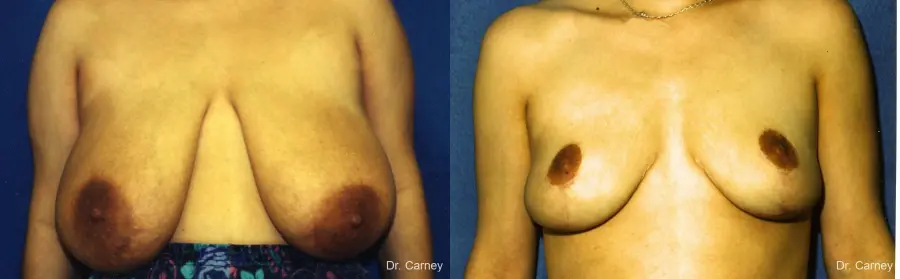 Virginia Beach Breast Lift 1191 - Before and After 1