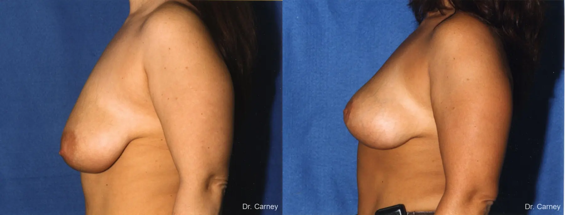 Virginia Beach Breast Lift 1187 - Before and After 2