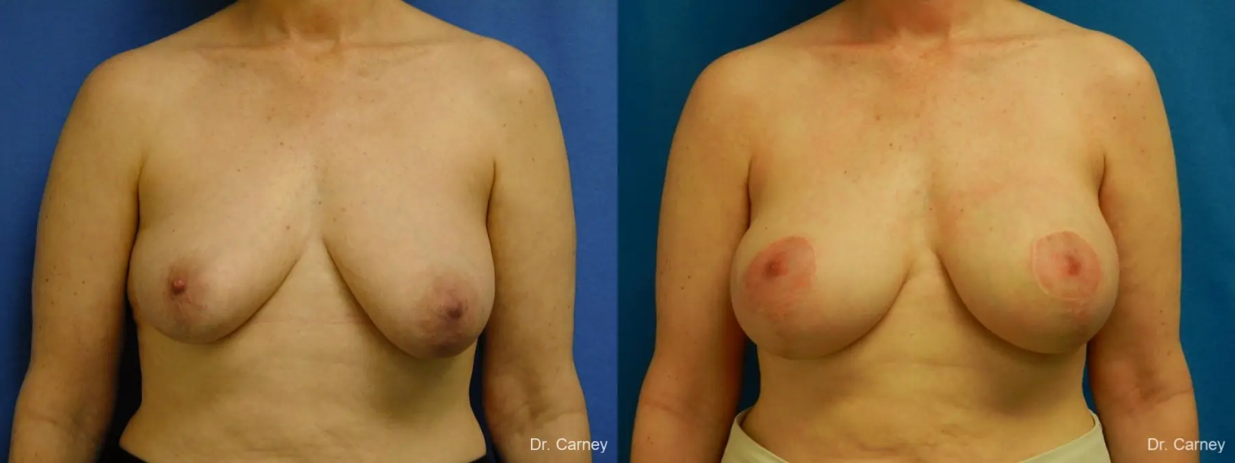 Virginia Beach Breast Lift 1185 - Before and After