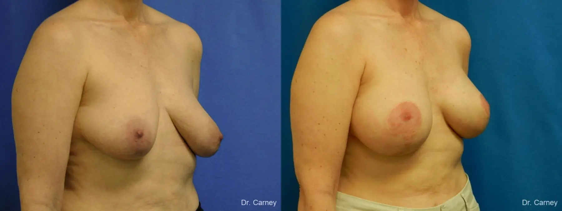 Virginia Beach Breast Lift 1185 - Before and After 2
