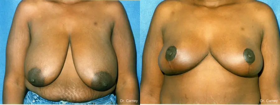 Virginia Beach Breast Lift 1189 - Before and After 1