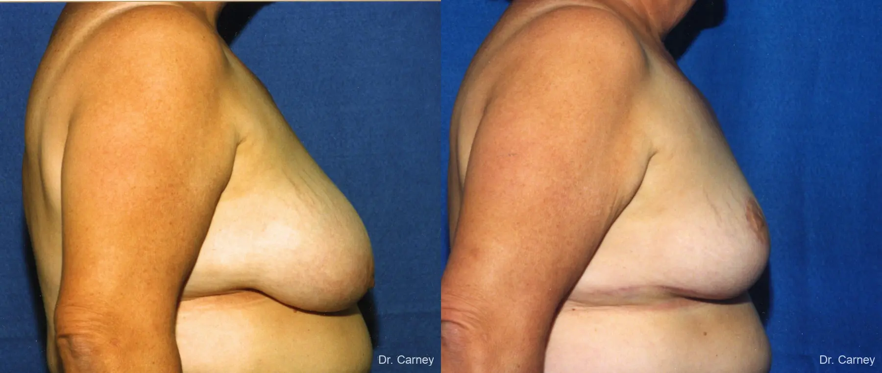 Virginia Beach Breast Lift 1186 - Before and After 2