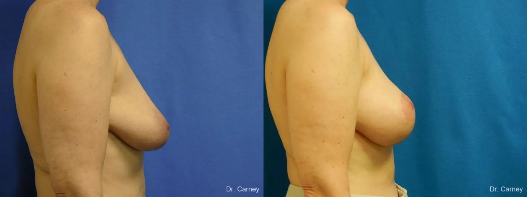 Virginia Beach Breast Lift 1185 - Before and After 3