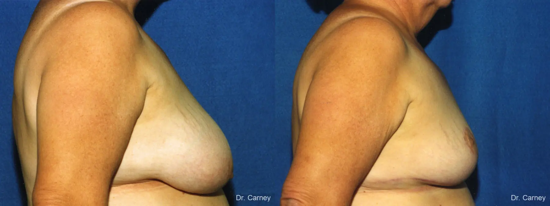 Virginia Beach Breast Reduction 1234 - Before and After 2