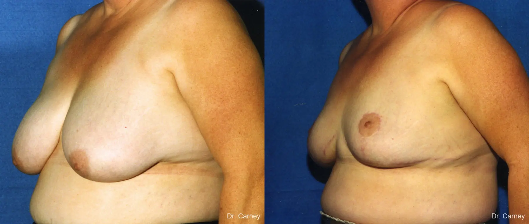 Virginia Beach Breast Reduction 1234 - Before and After 3