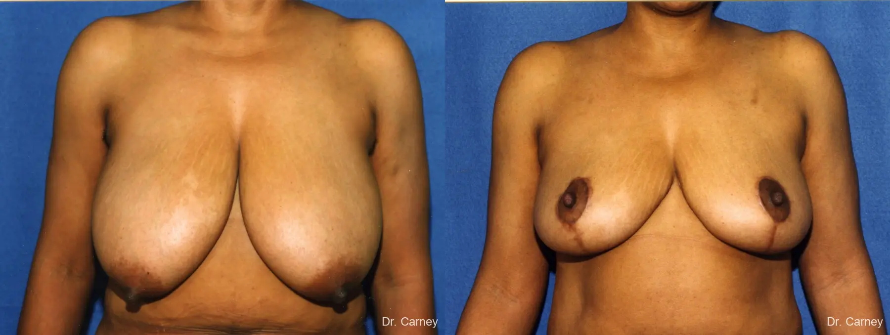 Virginia Beach Breast Reduction 1228. - Before and After 1