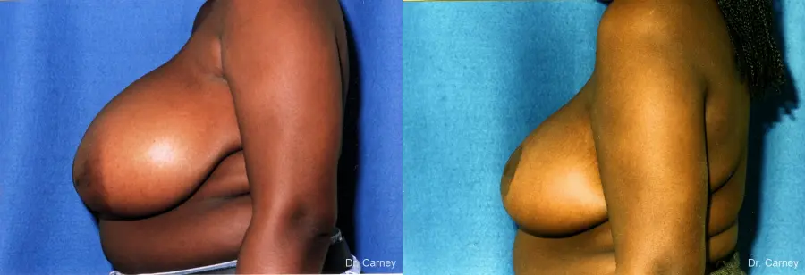 Virginia Beach Breast Reduction 1233 - Before and After 2
