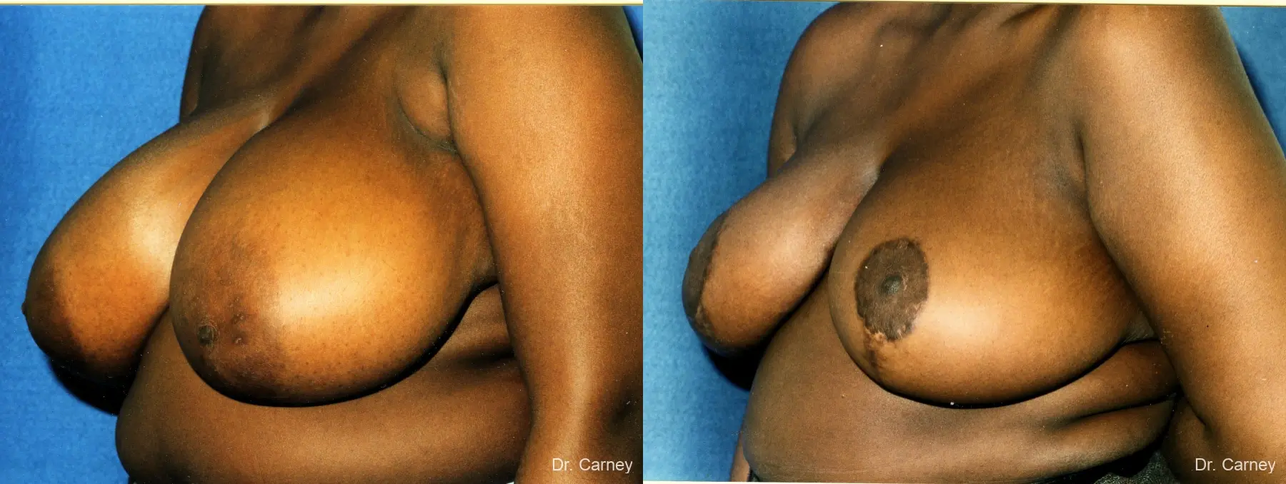 Virginia Beach Breast Reduction 1233 - Before and After 1