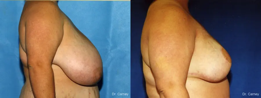 Virginia Beach Breast Reduction 1232 - Before and After 2