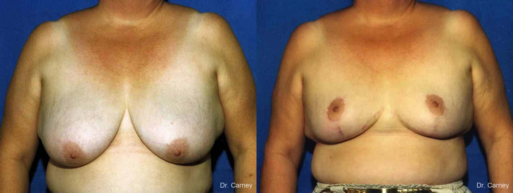 Virginia Beach Breast Reduction 1234 - Before and After 1