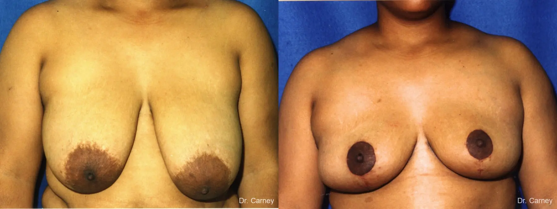 Virginia Beach Breast Reduction 1231 - Before and After