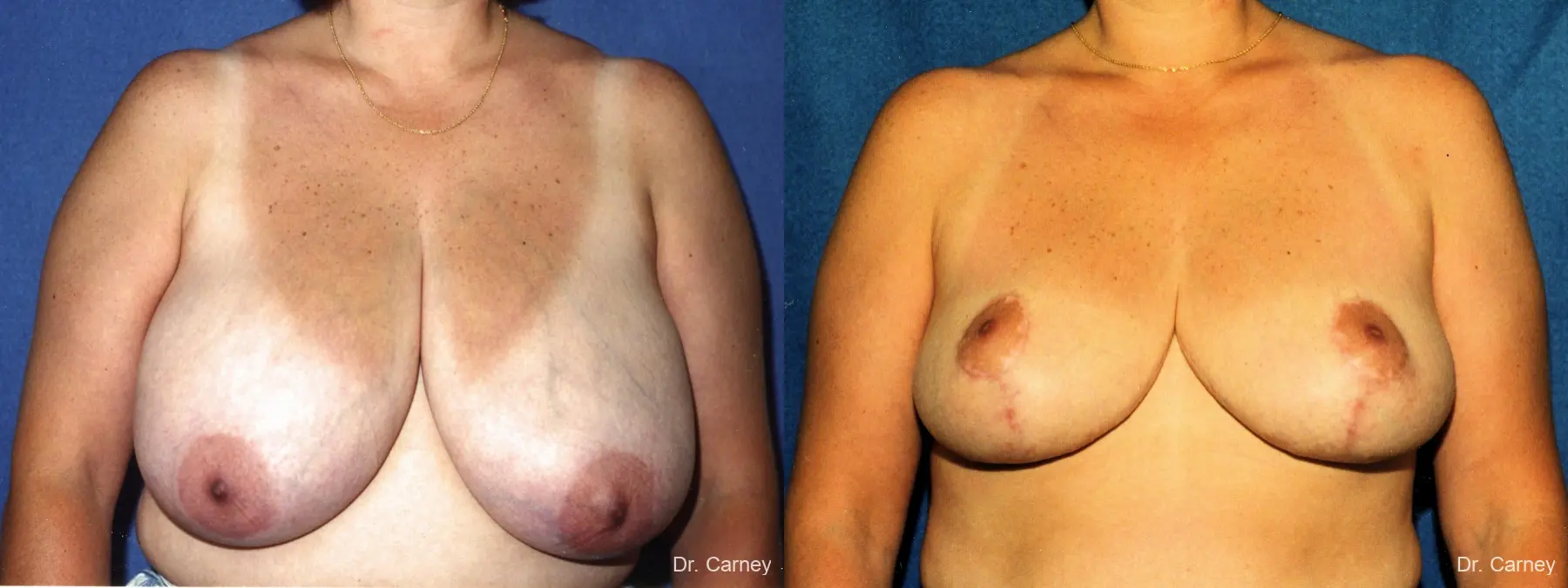 Virginia Beach Breast Reduction 1229 - Before and After 1