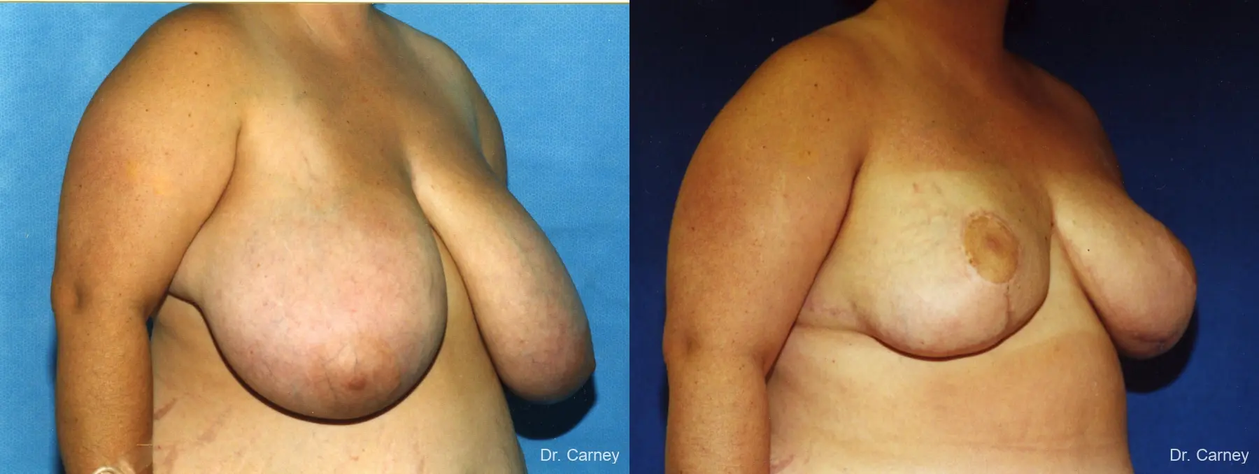 Virginia Beach Breast Reduction 1232 - Before and After