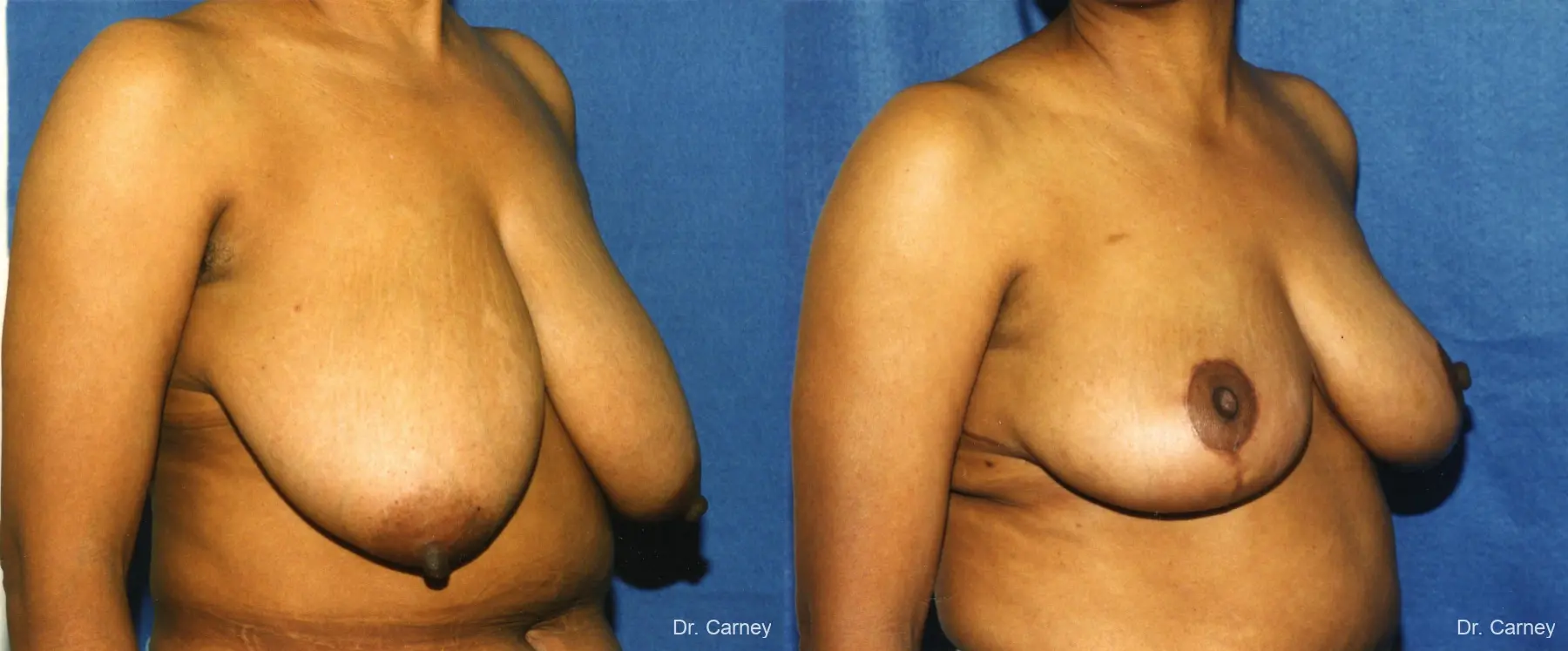 Virginia Beach Breast Reduction 1228. - Before and After 2