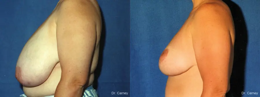 Virginia Beach Breast Reduction 1229 - Before and After 2