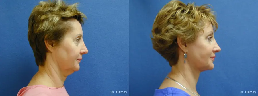 Virginia Beach Brow Lift 1216 - Before and After 5