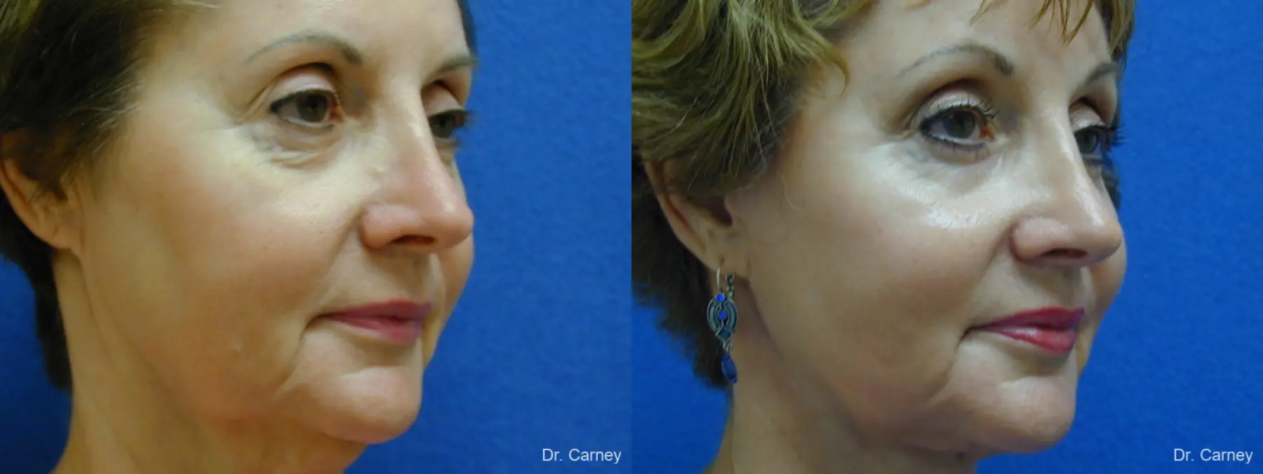 Virginia Beach Brow Lift 1216 - Before and After 1