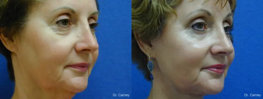 Virginia Beach Brow Lift 1216 - Before and After 1