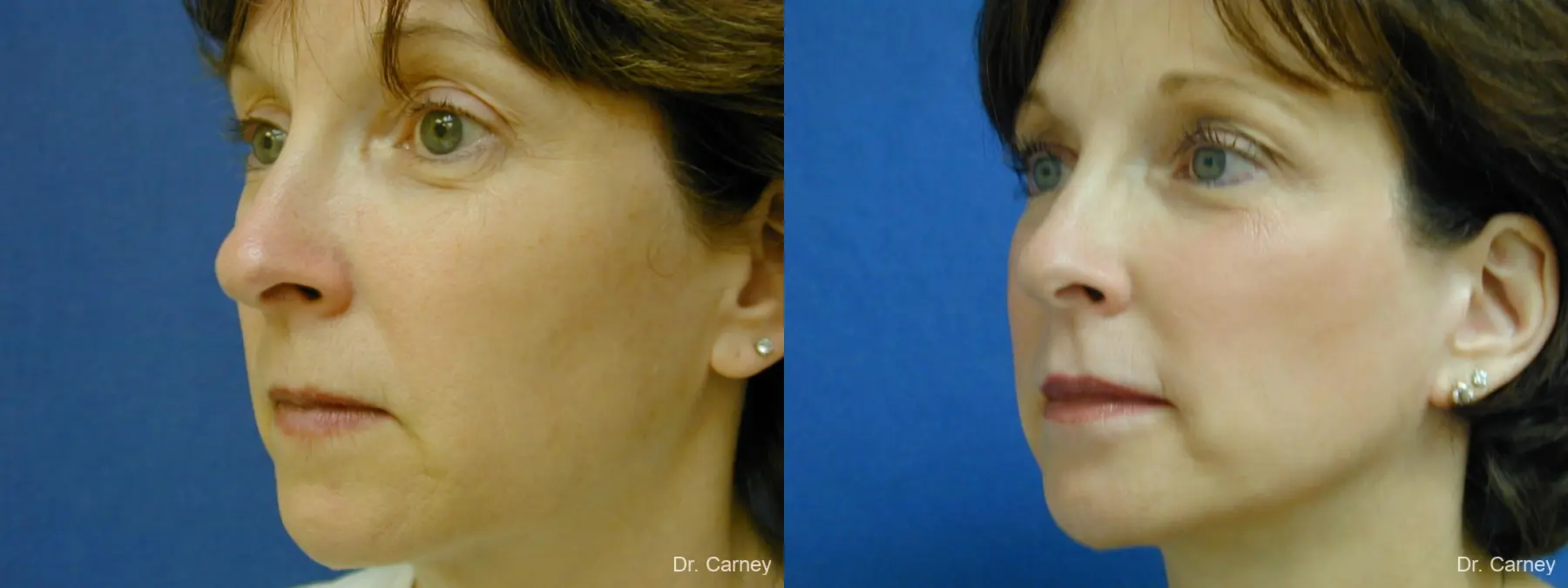 Virginia Beach Brow Lift 1217 - Before and After 4