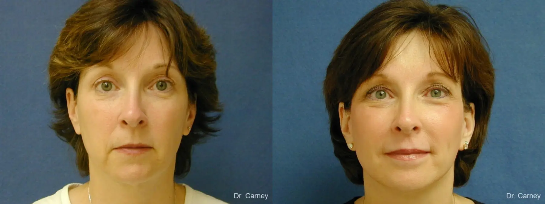Virginia Beach Brow Lift 1217 - Before and After