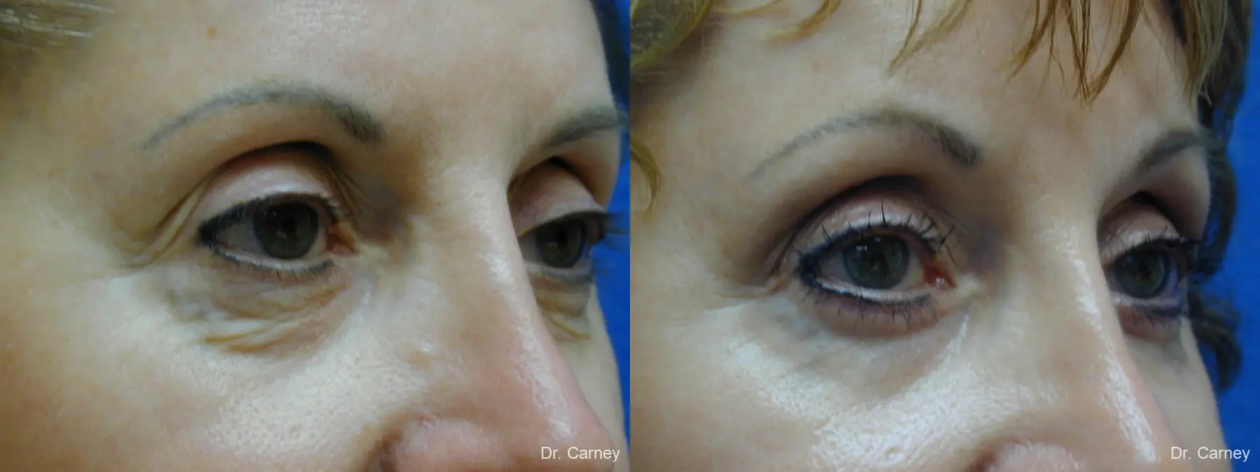 Virginia Beach Brow Lift 1216 - Before and After 2
