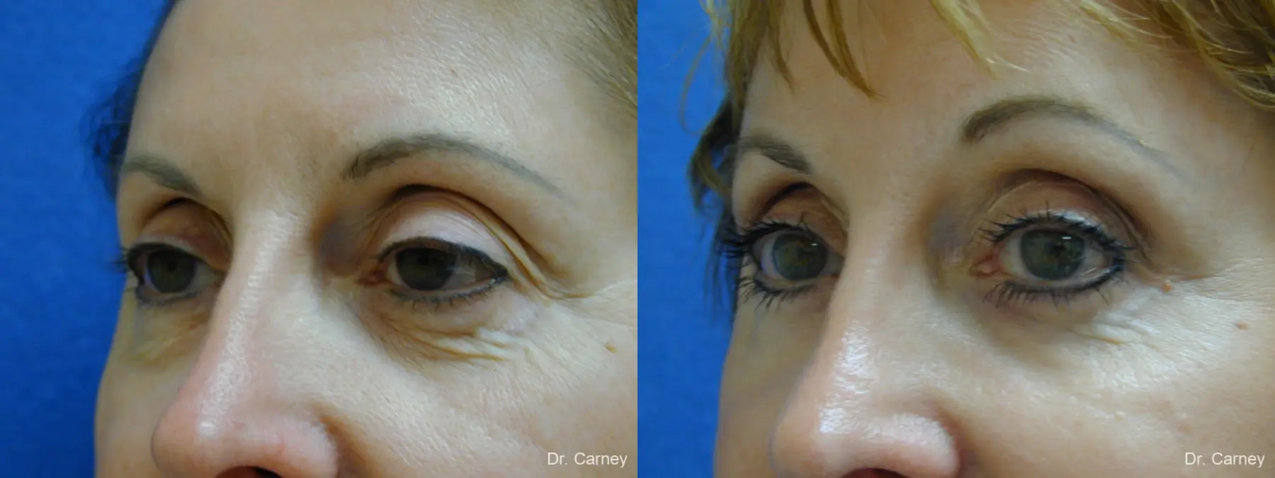 Virginia Beach Brow Lift 1216 - Before and After 3
