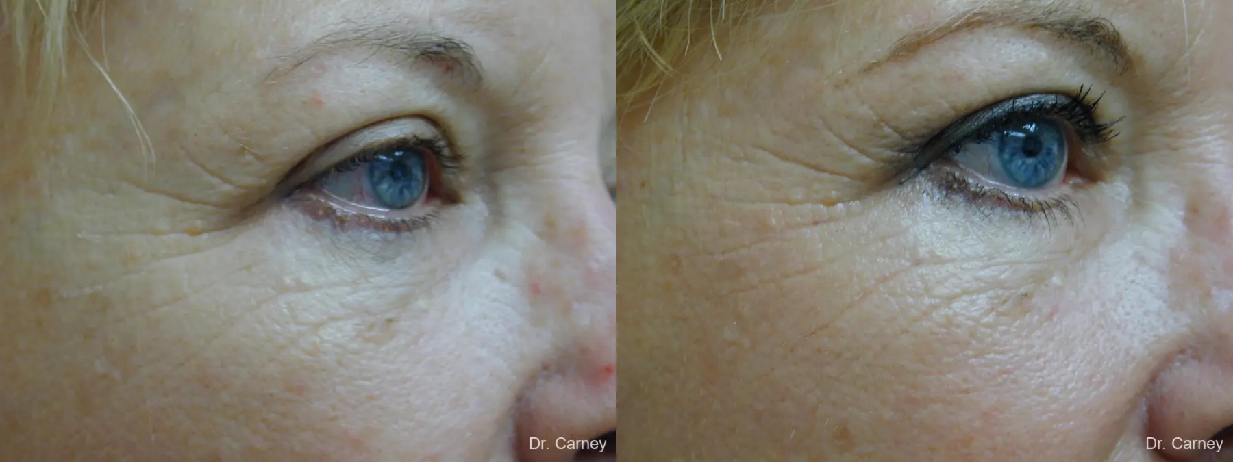 Virginia Beach Brow Lift 1266 - Before and After 4