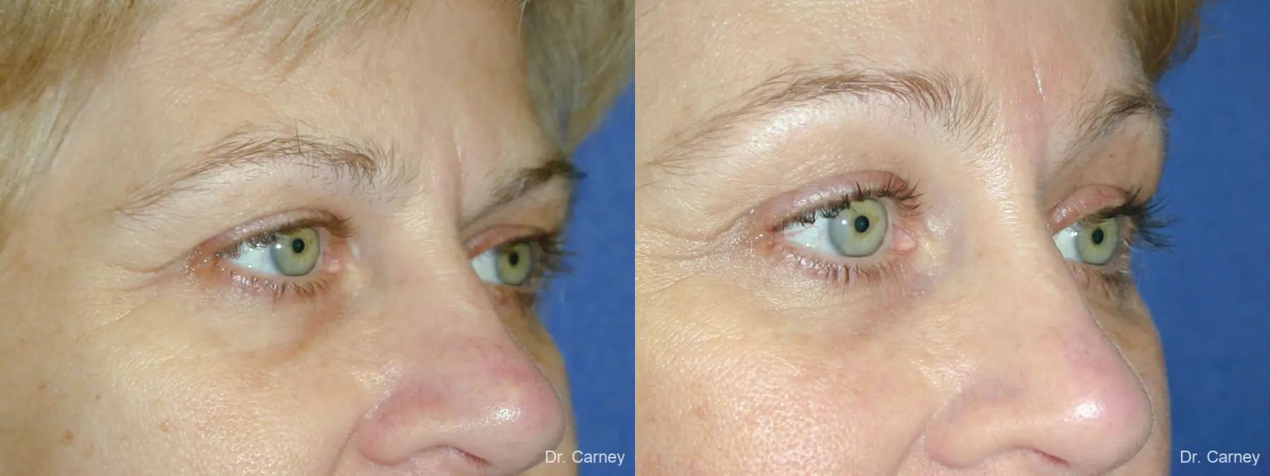 Virginia Beach Brow Lift 1345 - Before and After 4