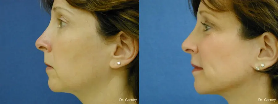 Virginia Beach Brow Lift 1217 - Before and After 3