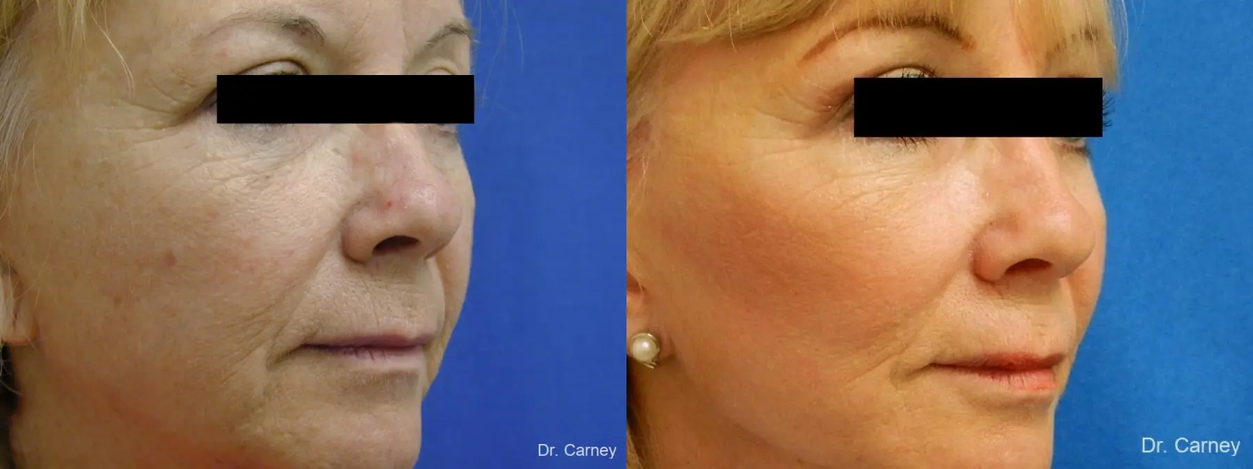 Virginia Beach Brow Lift 1266 - Before and After