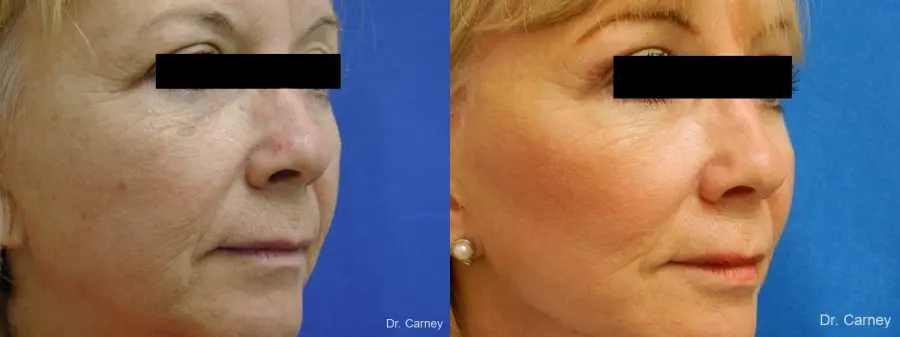 Virginia Beach Brow Lift 1266 - Before and After 1