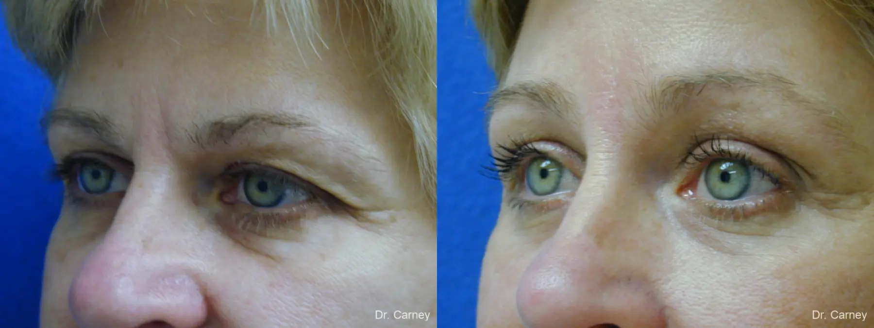 Virginia Beach Brow Lift 1345 - Before and After 3